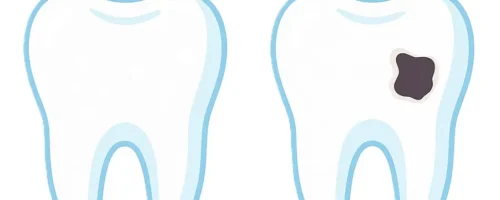 was Karies und White Spots über unsere Zähne verraten