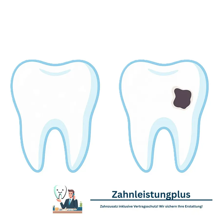 Karies und White Spots