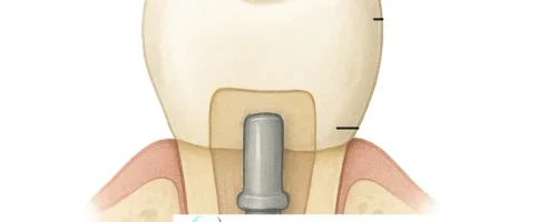 Wie der Stiftzahn Ihr Lächeln rettet