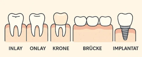 Zahnersatz verstehen: Was wirklich dahinter steckt